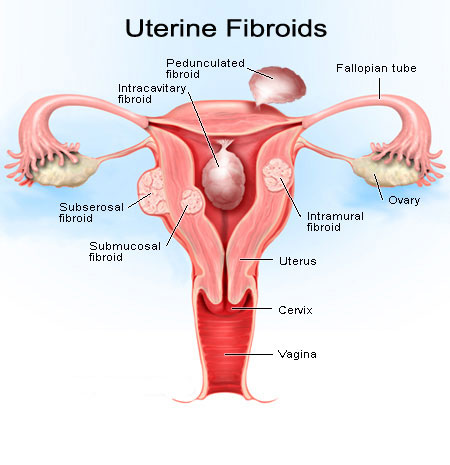 Uterine 2BFibroids